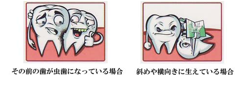 その前の歯が虫歯になっている場合　斜めや横向きに生えている場合